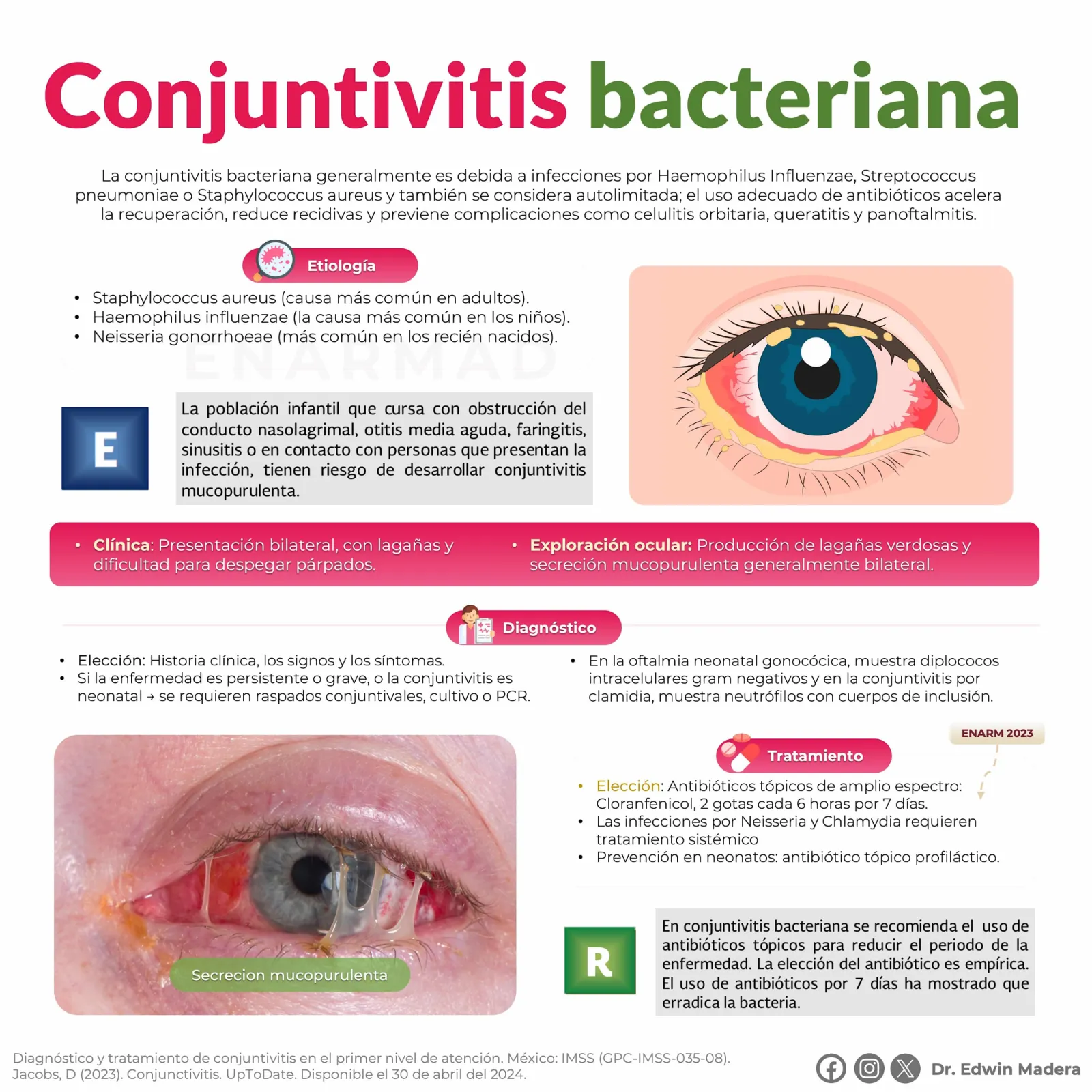 Conjuntivitis bacteriana
