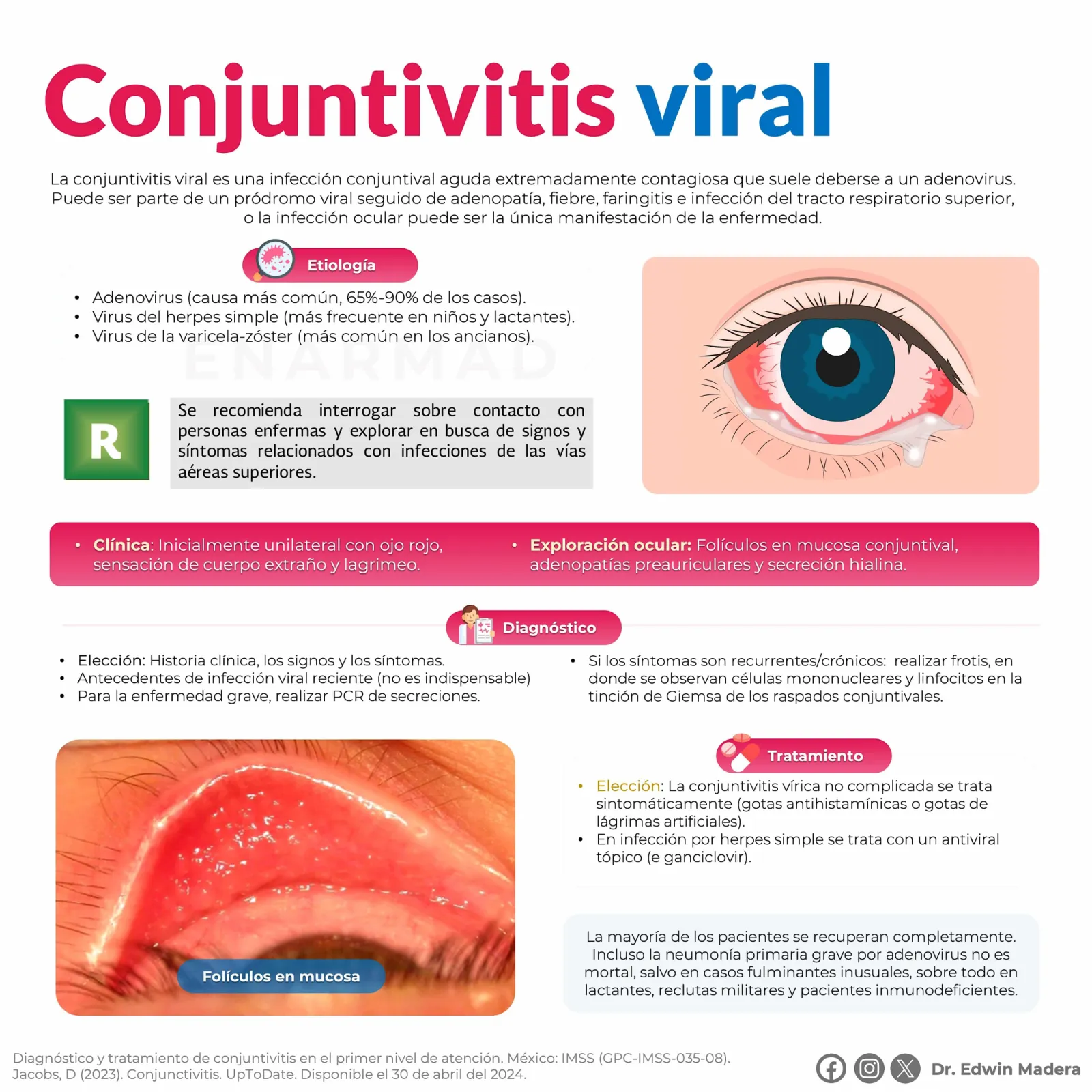 Conjuntivitis Viral