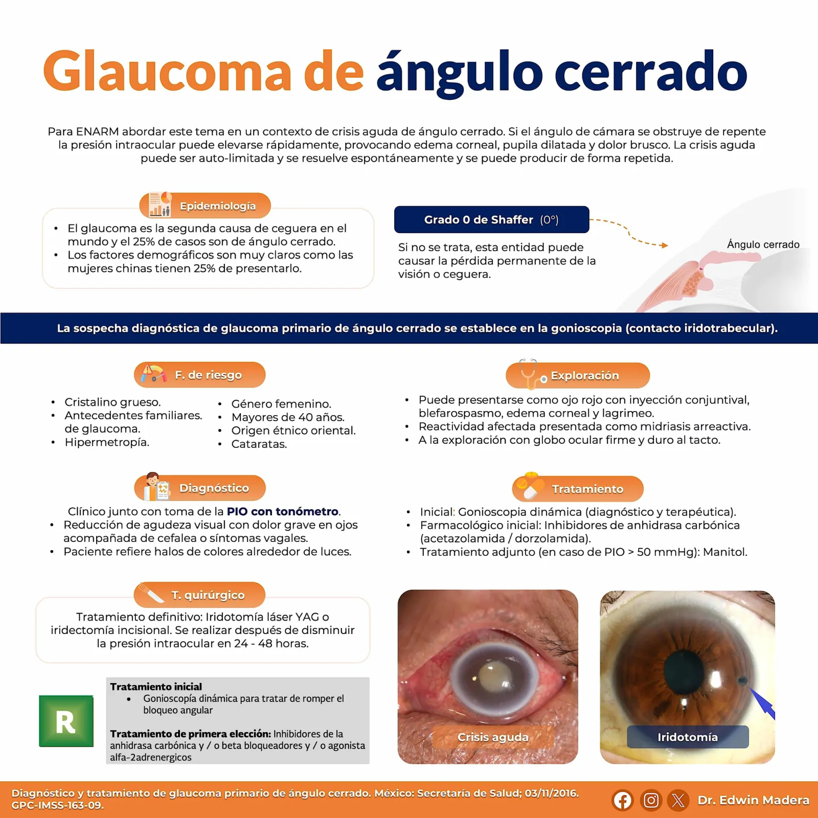 Glaucoma de ángulo cerrado
