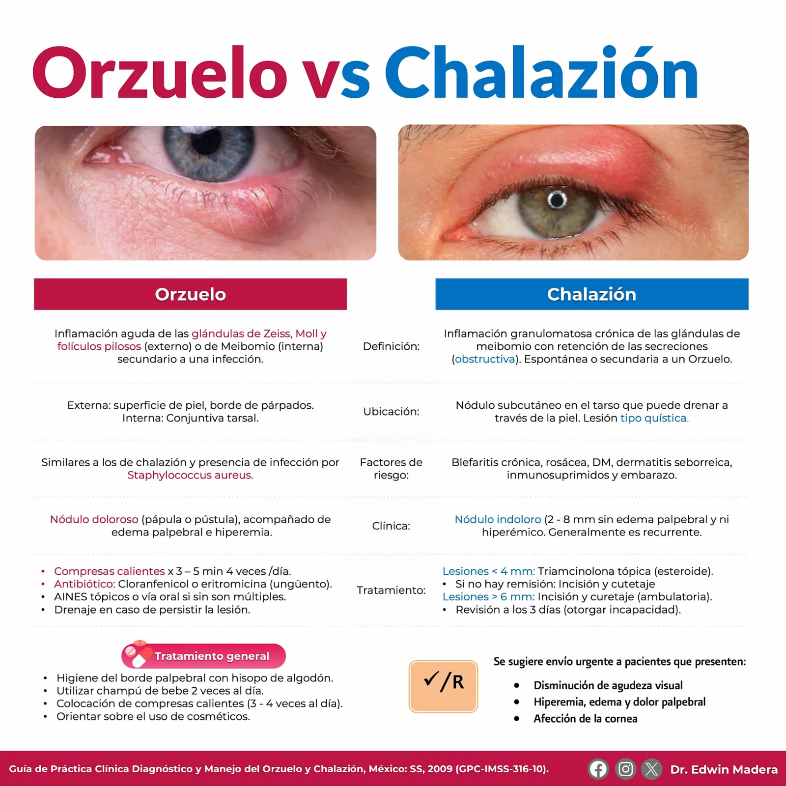 Orzuelo