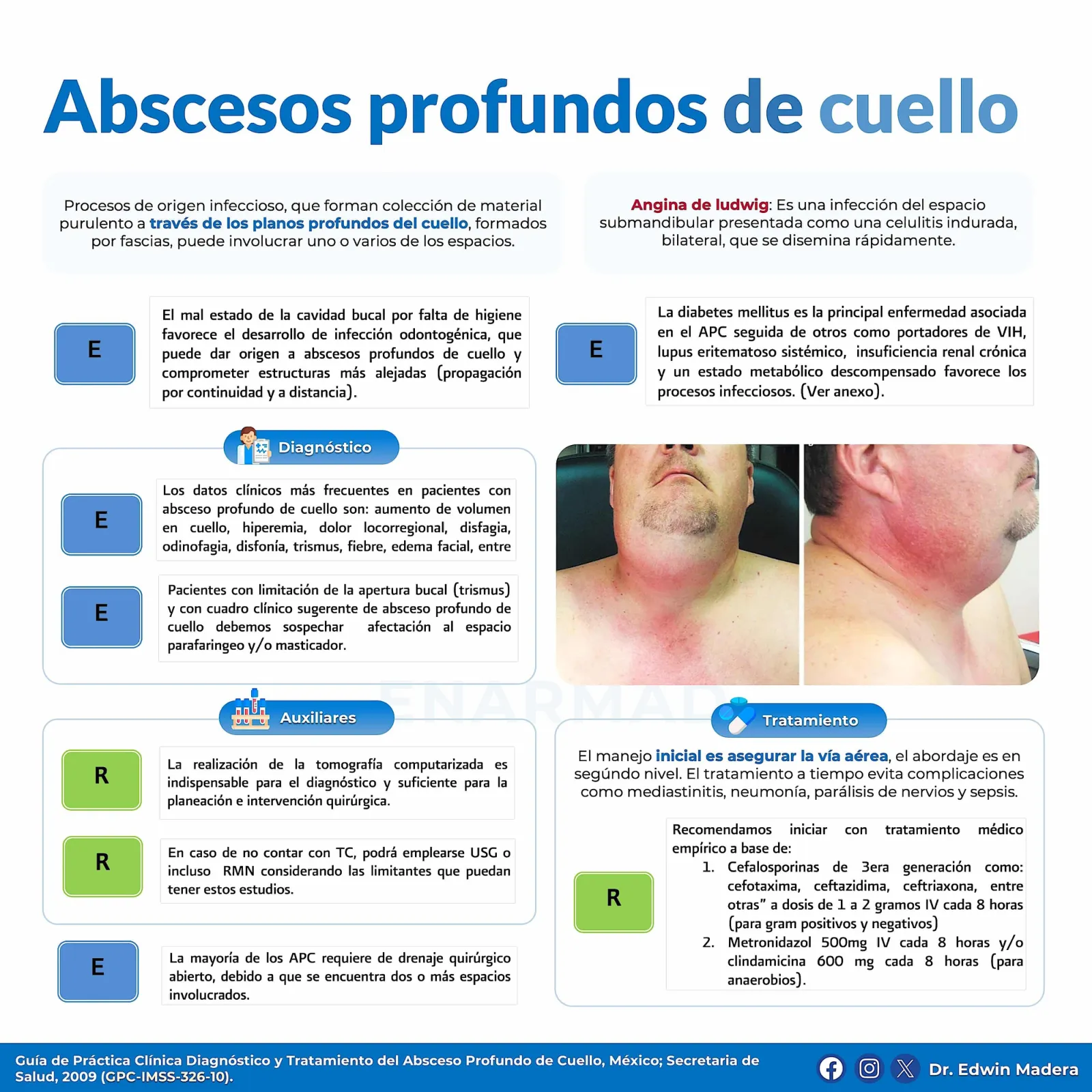 Abscesos profundos de cuello