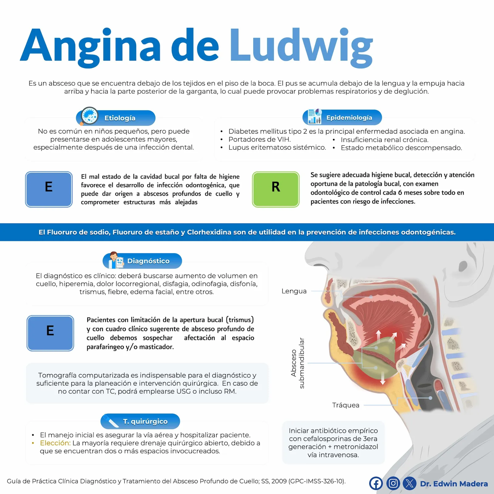 Angina de Ludwig