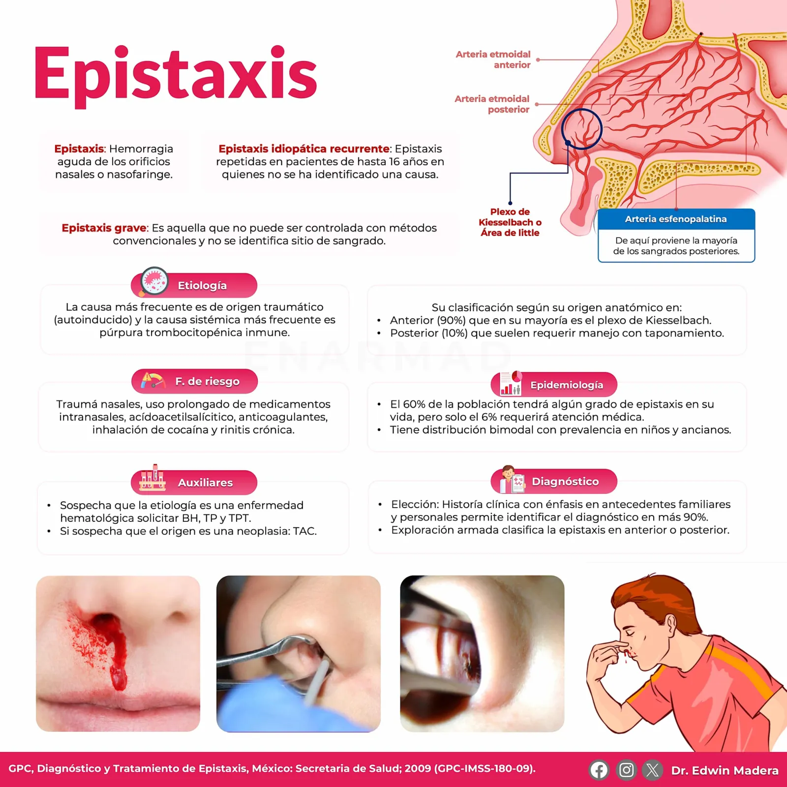 Epistaxis