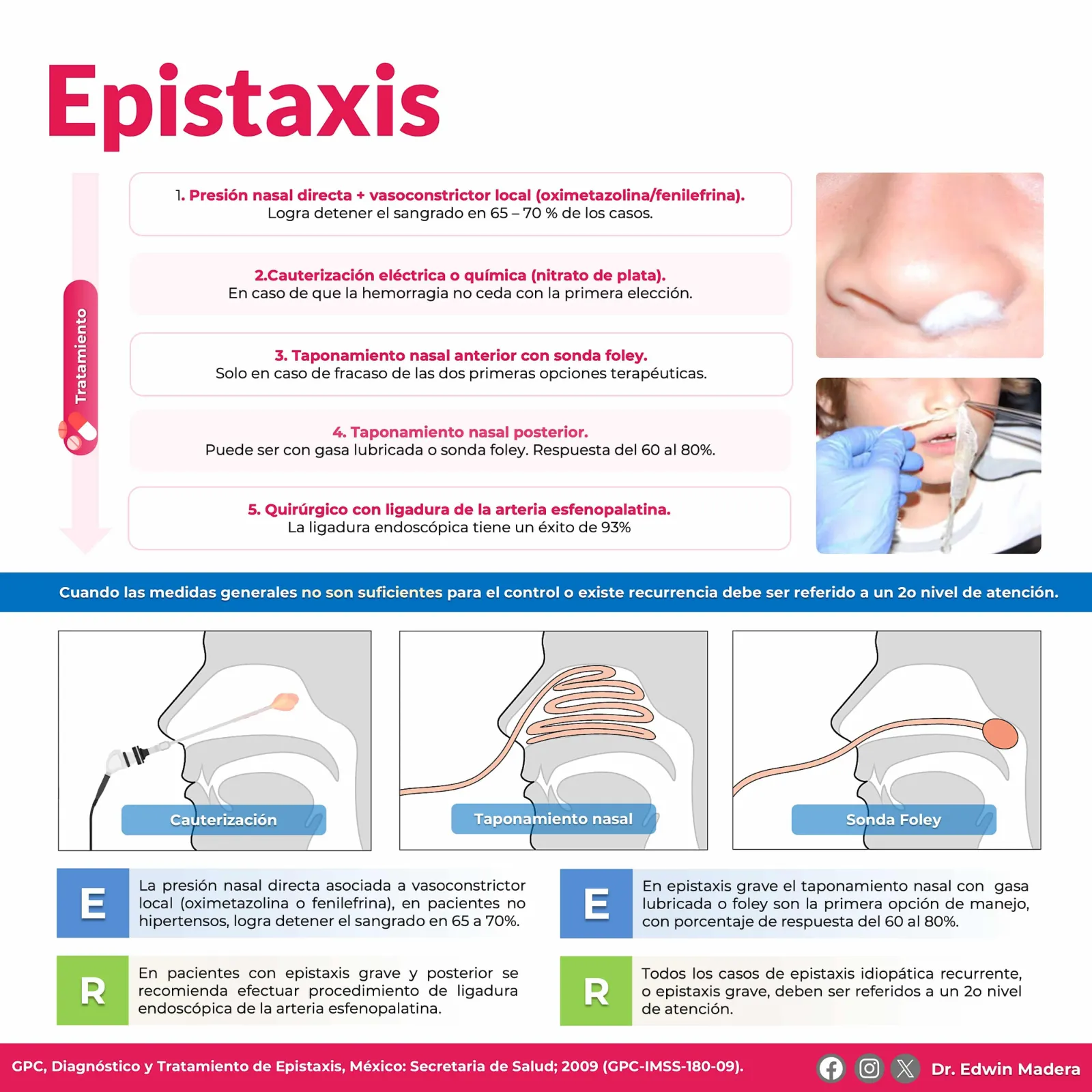 Epistaxis