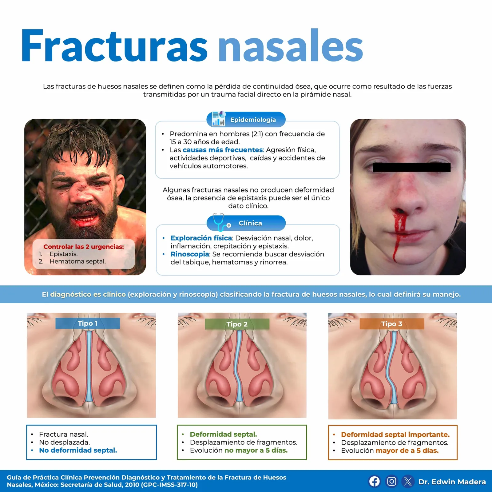 Fracturas nasales