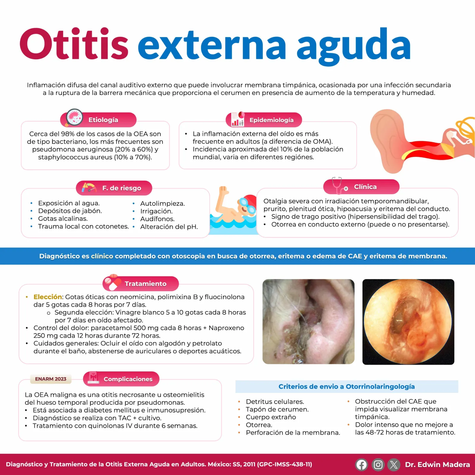 Otitis externa aguda