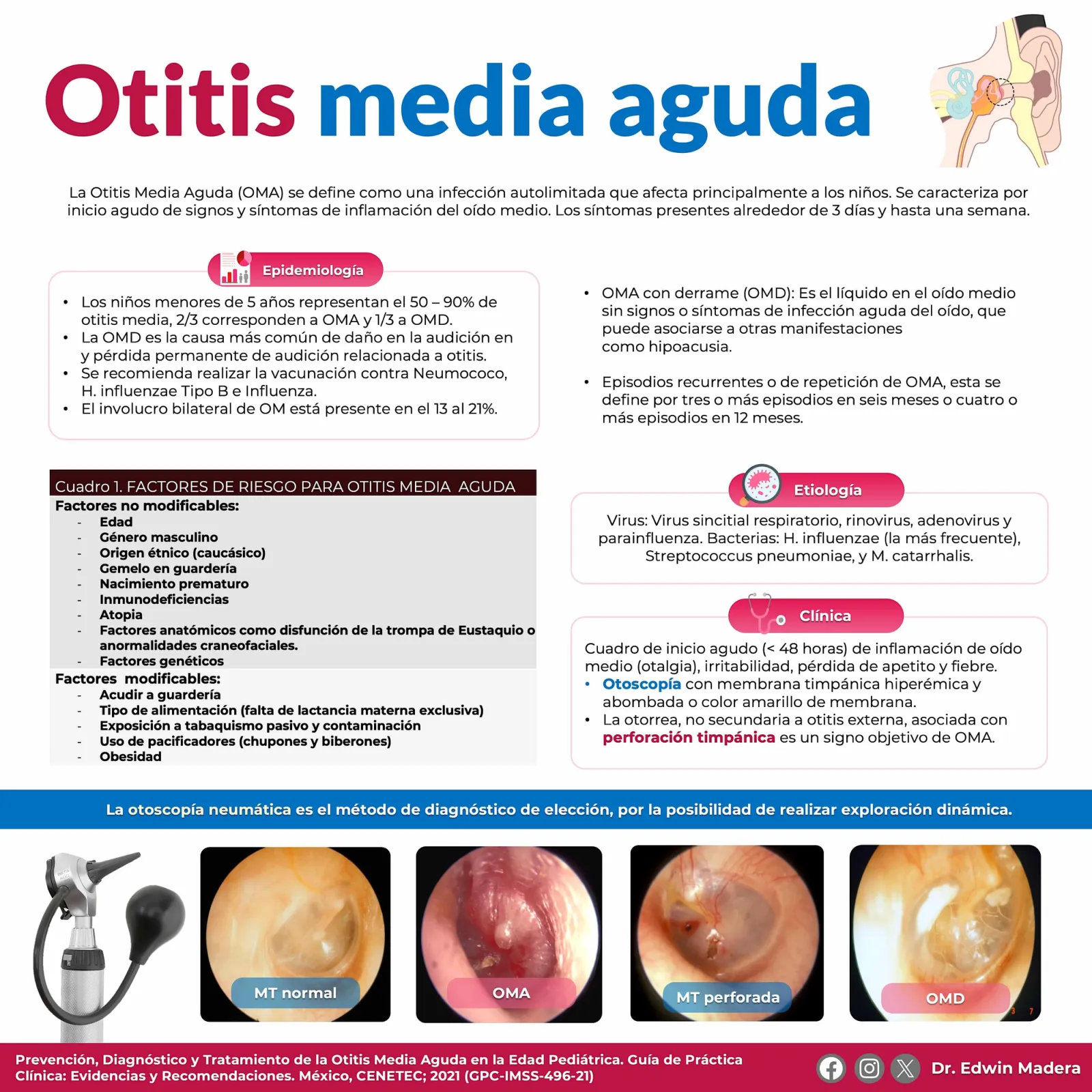 Otitis media aguda