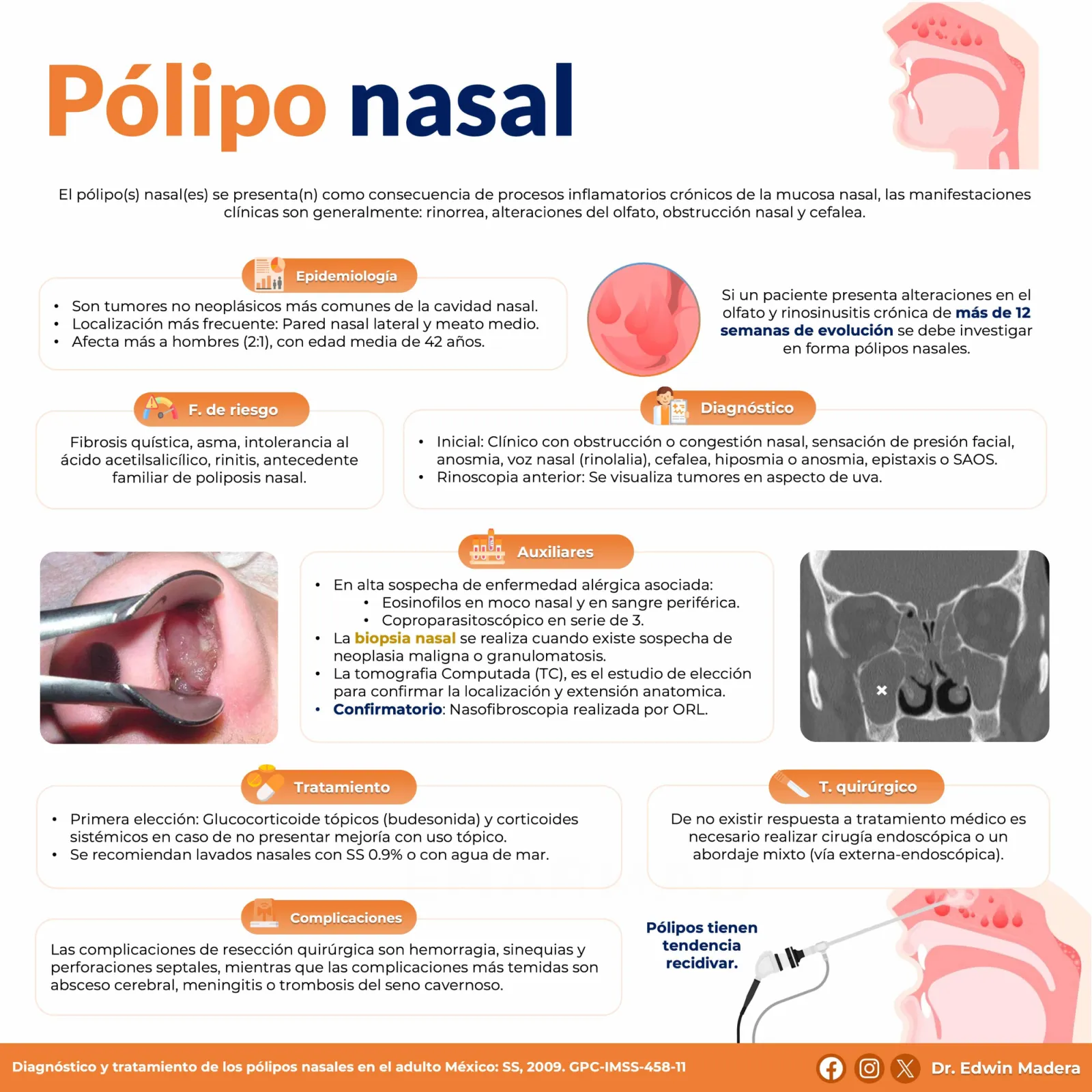 Pólipo nasal