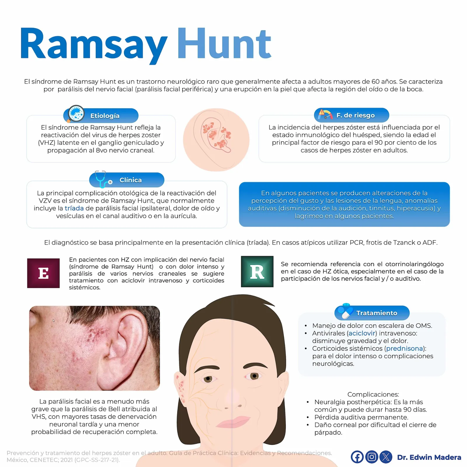 Síndrome de Ramsay Hunt