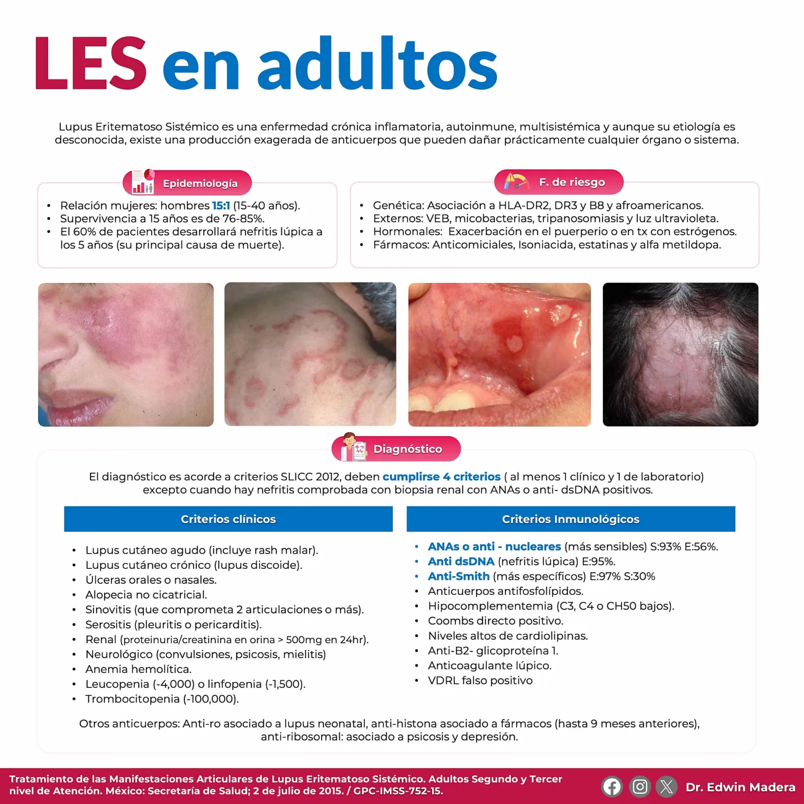 Lupus eritematoso sistémico