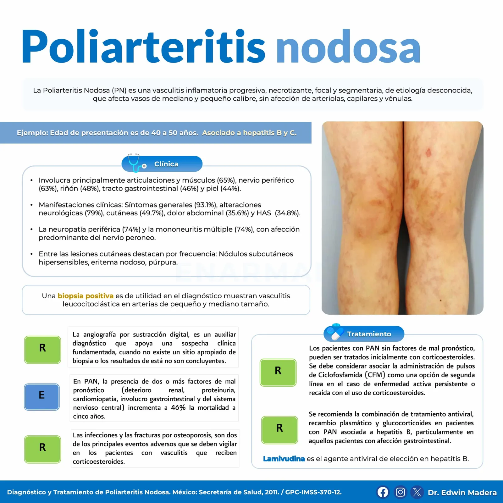 Poliarteritis nodosa