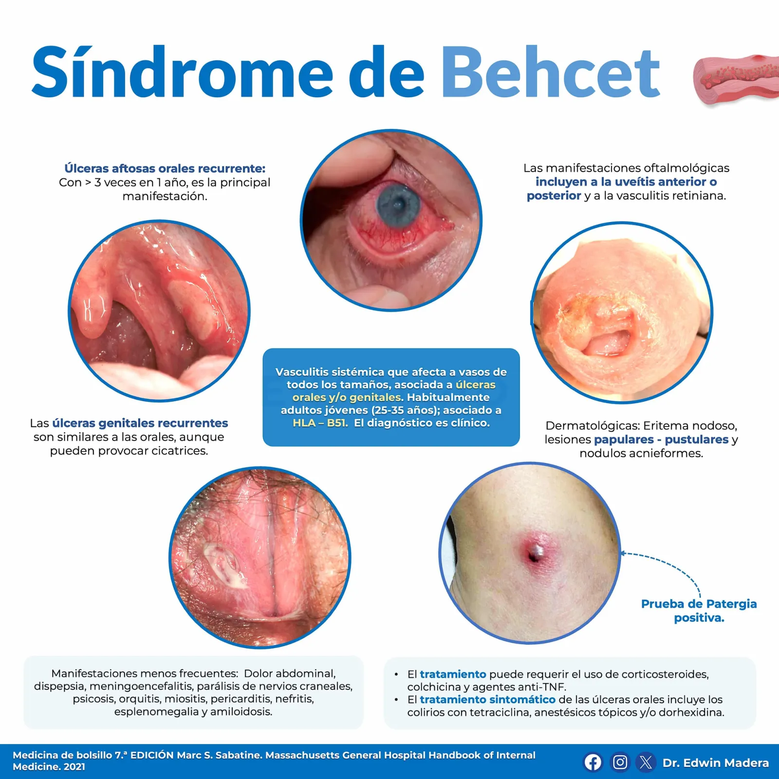 Síndrome de Behcet
