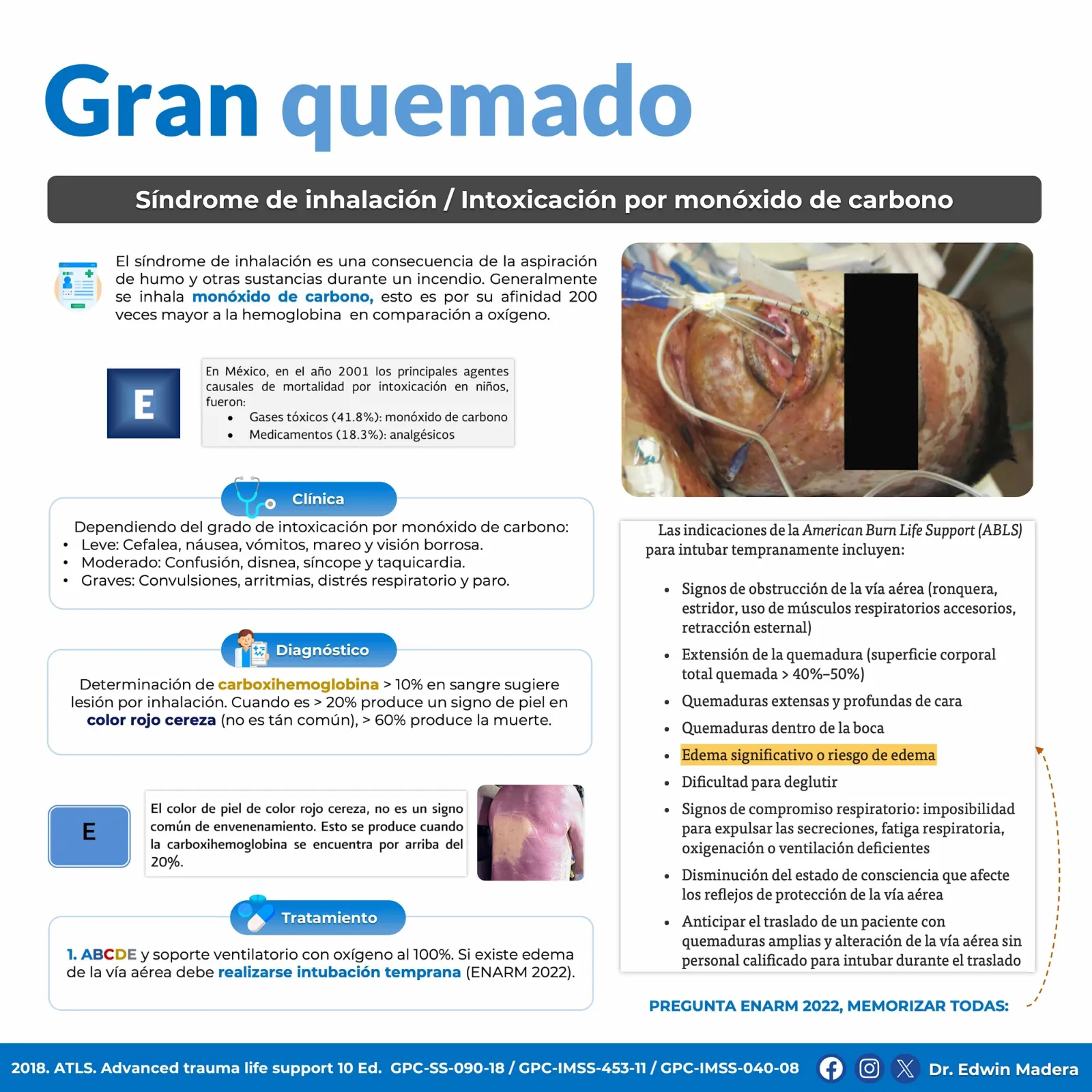 Intoxicación por monoxido de carbono