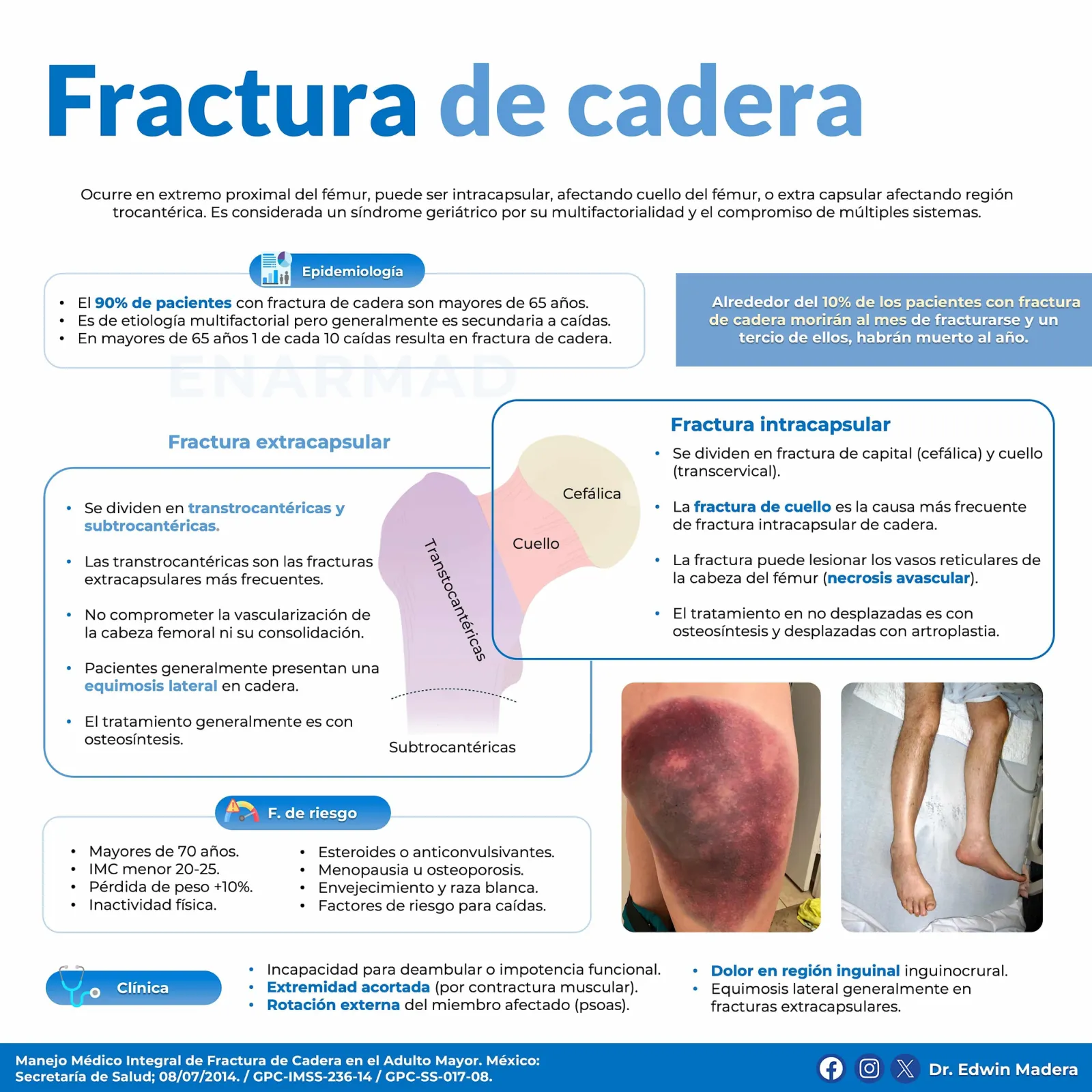 Fractura de cadera