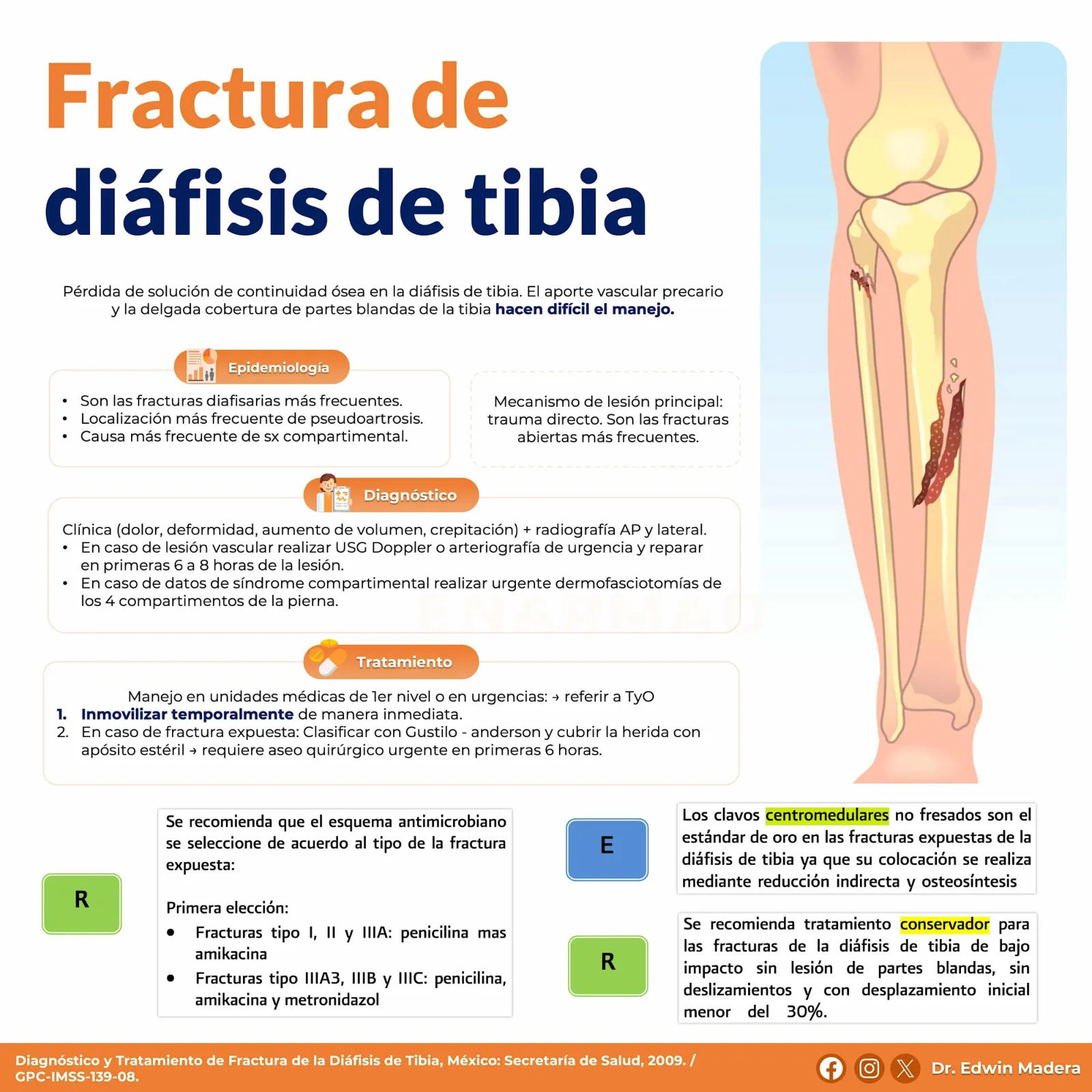 Fractura de diáfisis de tibia