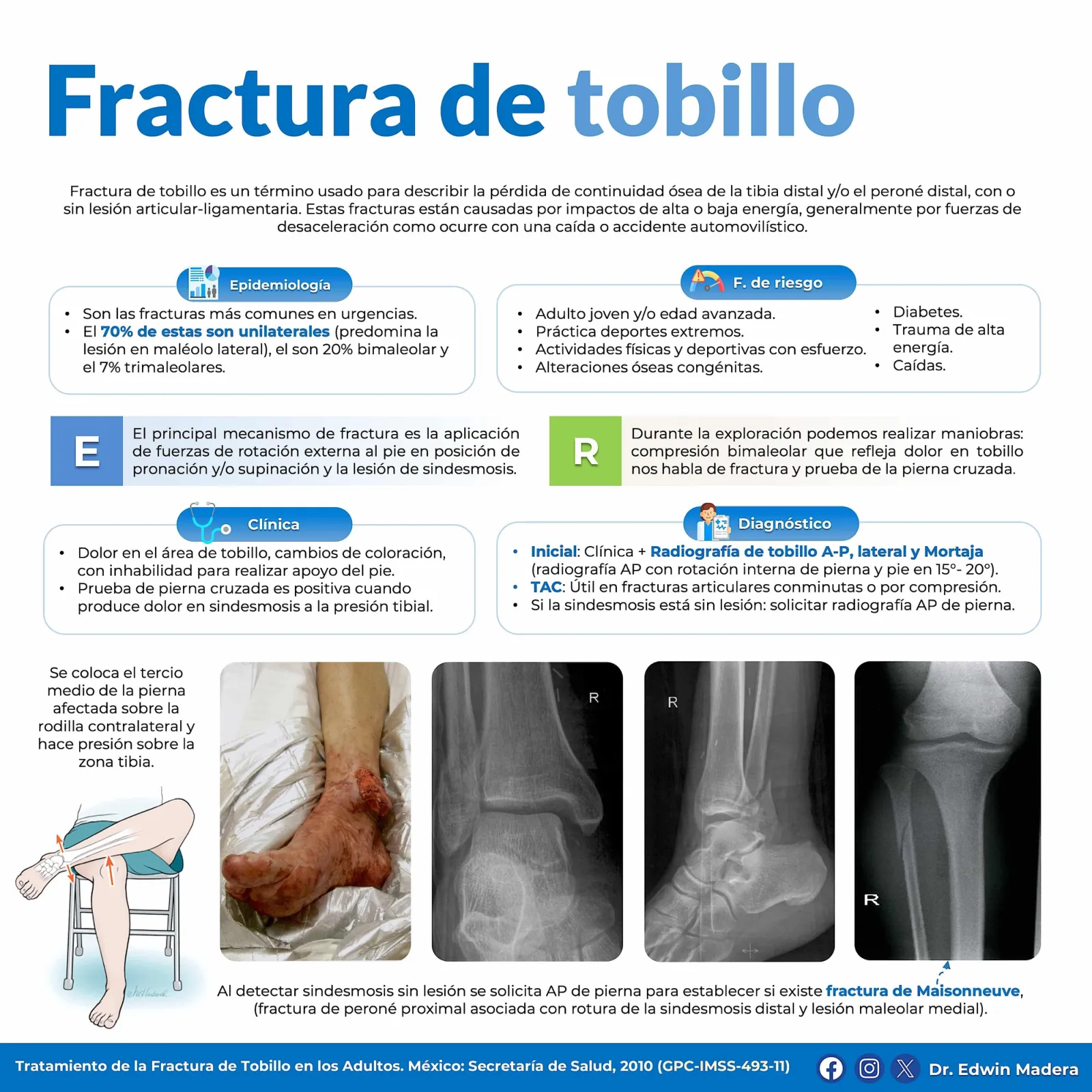 Fractura de tobillo
