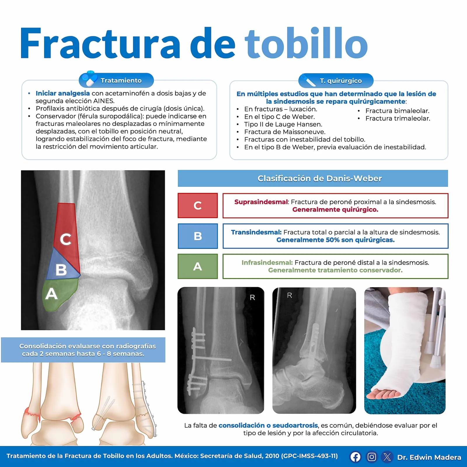Fractura de tobillo