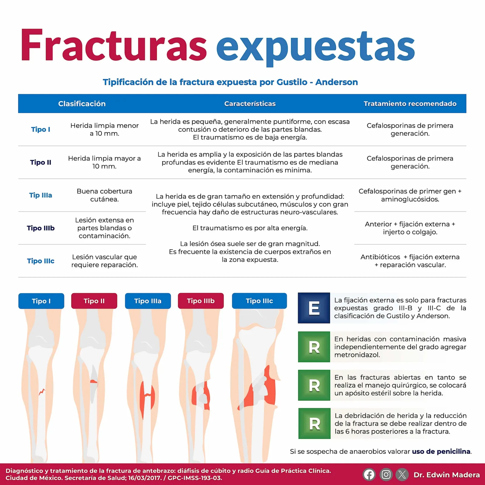 Fracturas expuestas