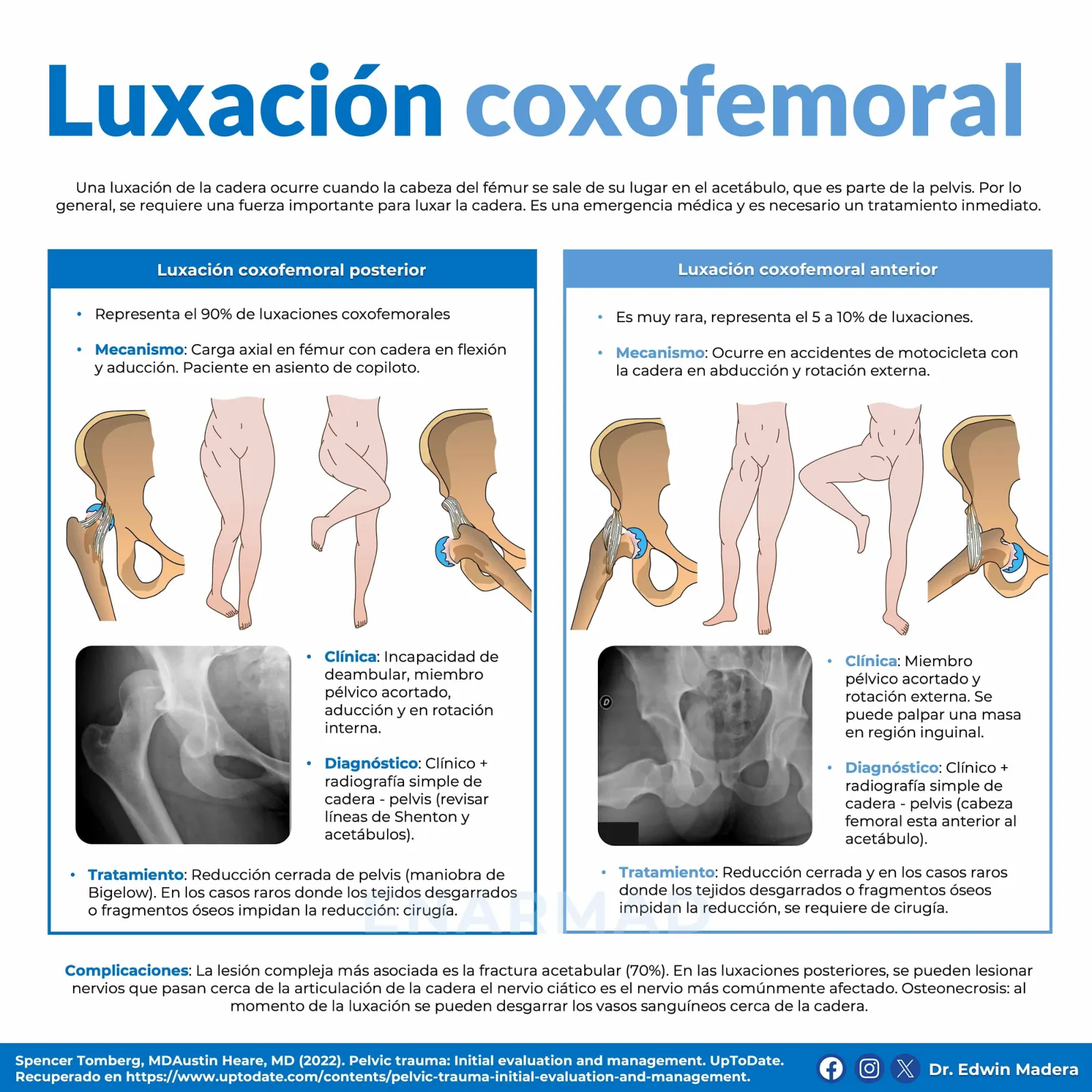Luxación coxofemoral