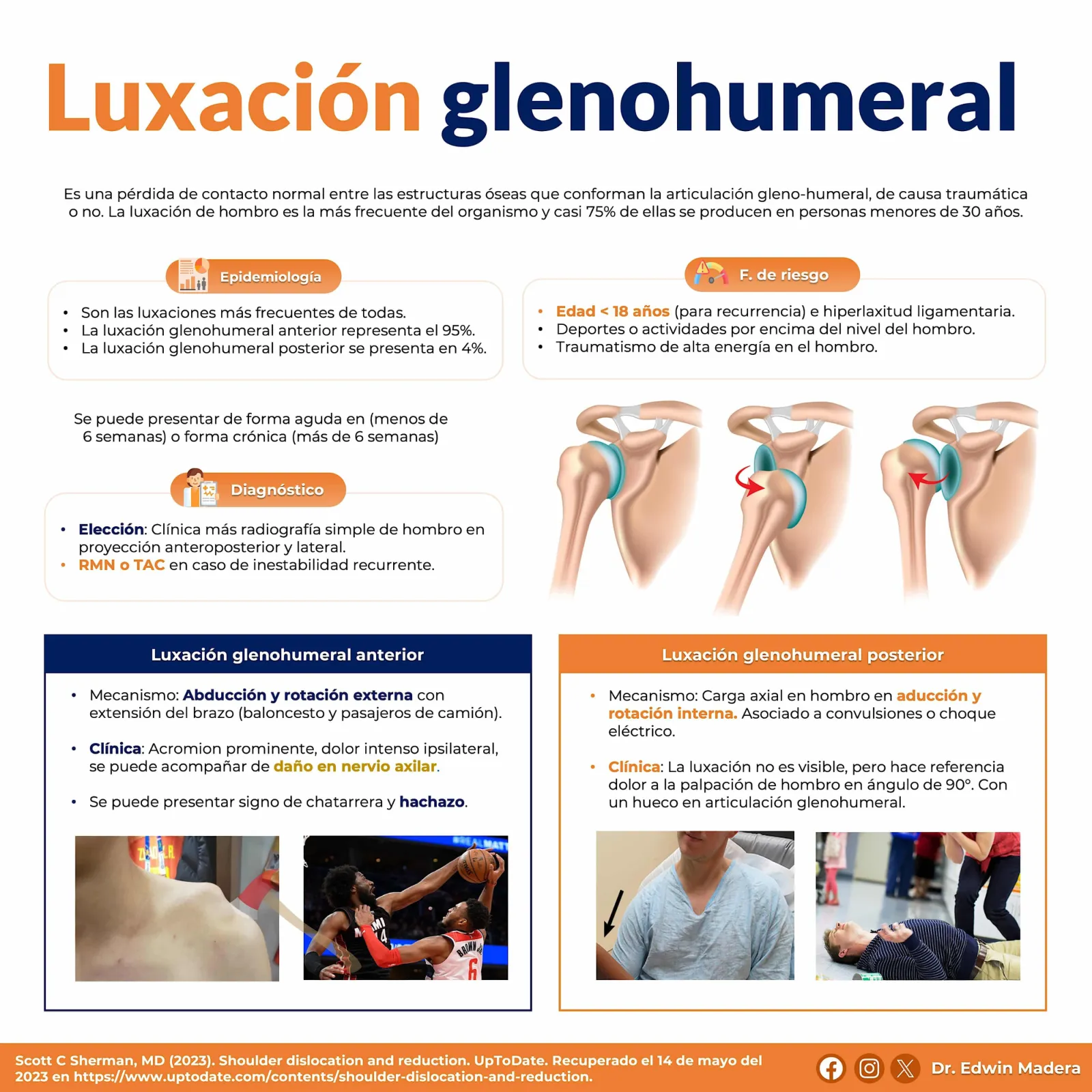 Luxación glenohumeral