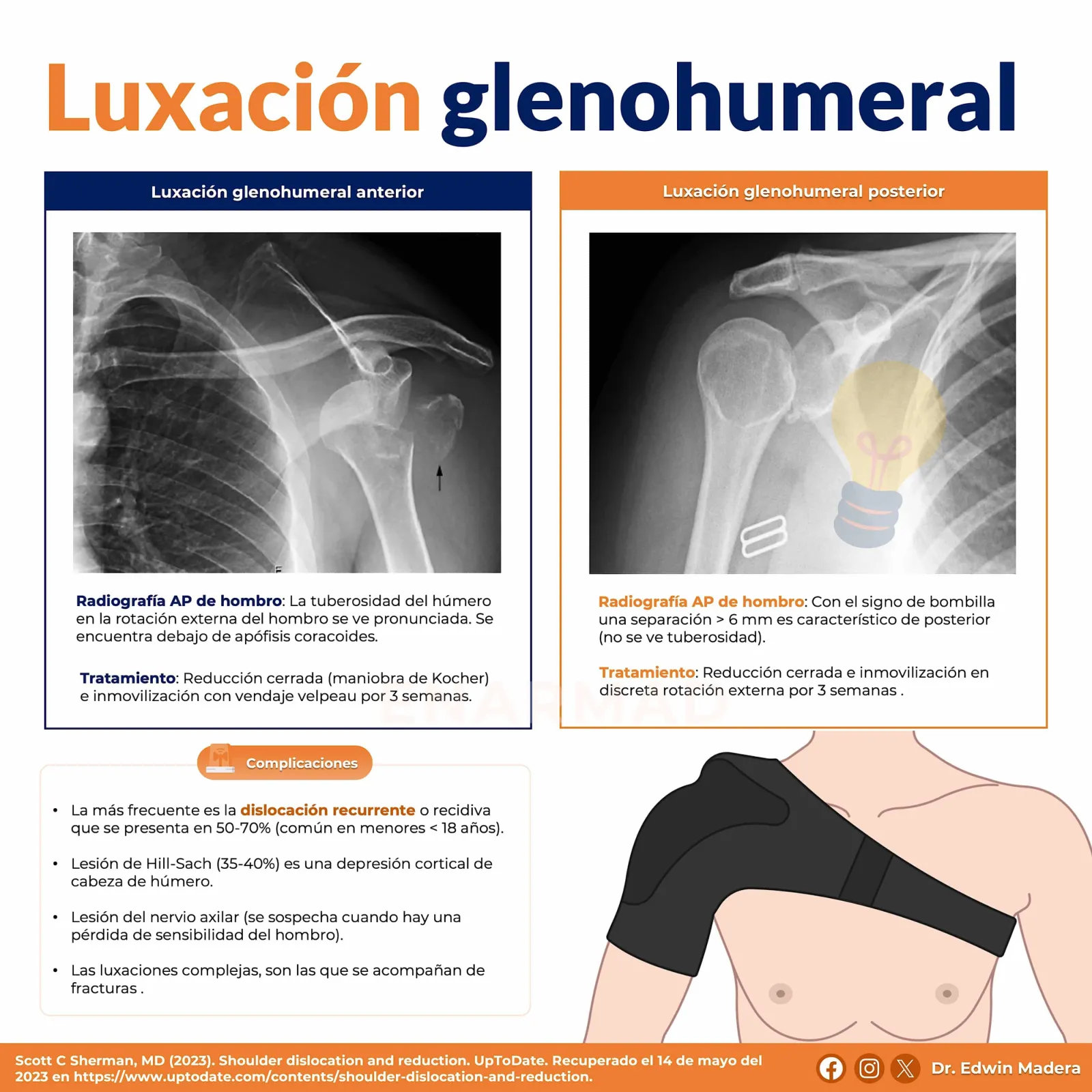Luxación glenohumeral