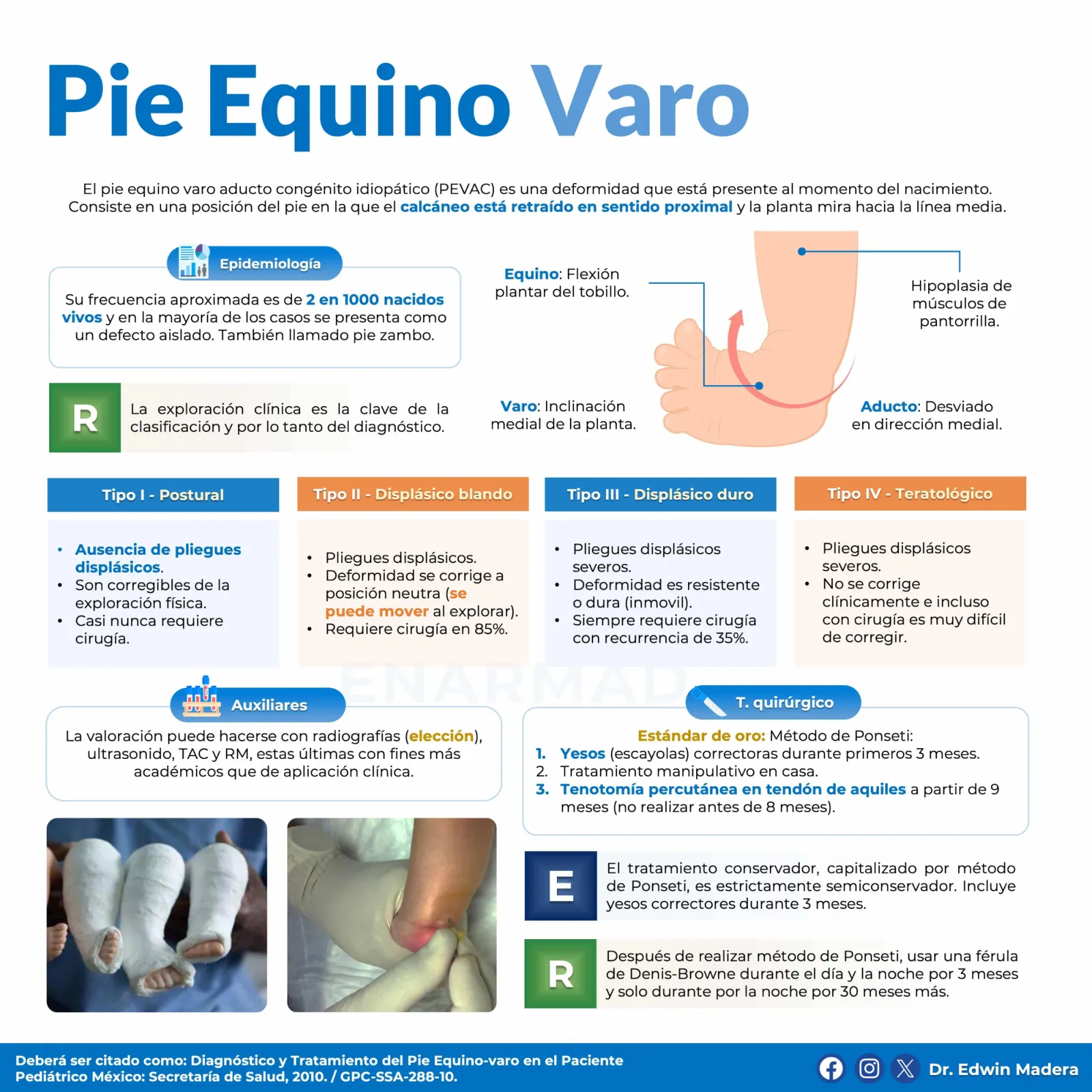 Pie equino varo
