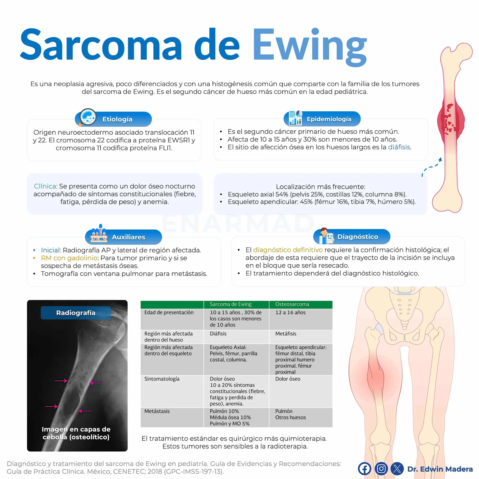 Sarcoma de Ewing