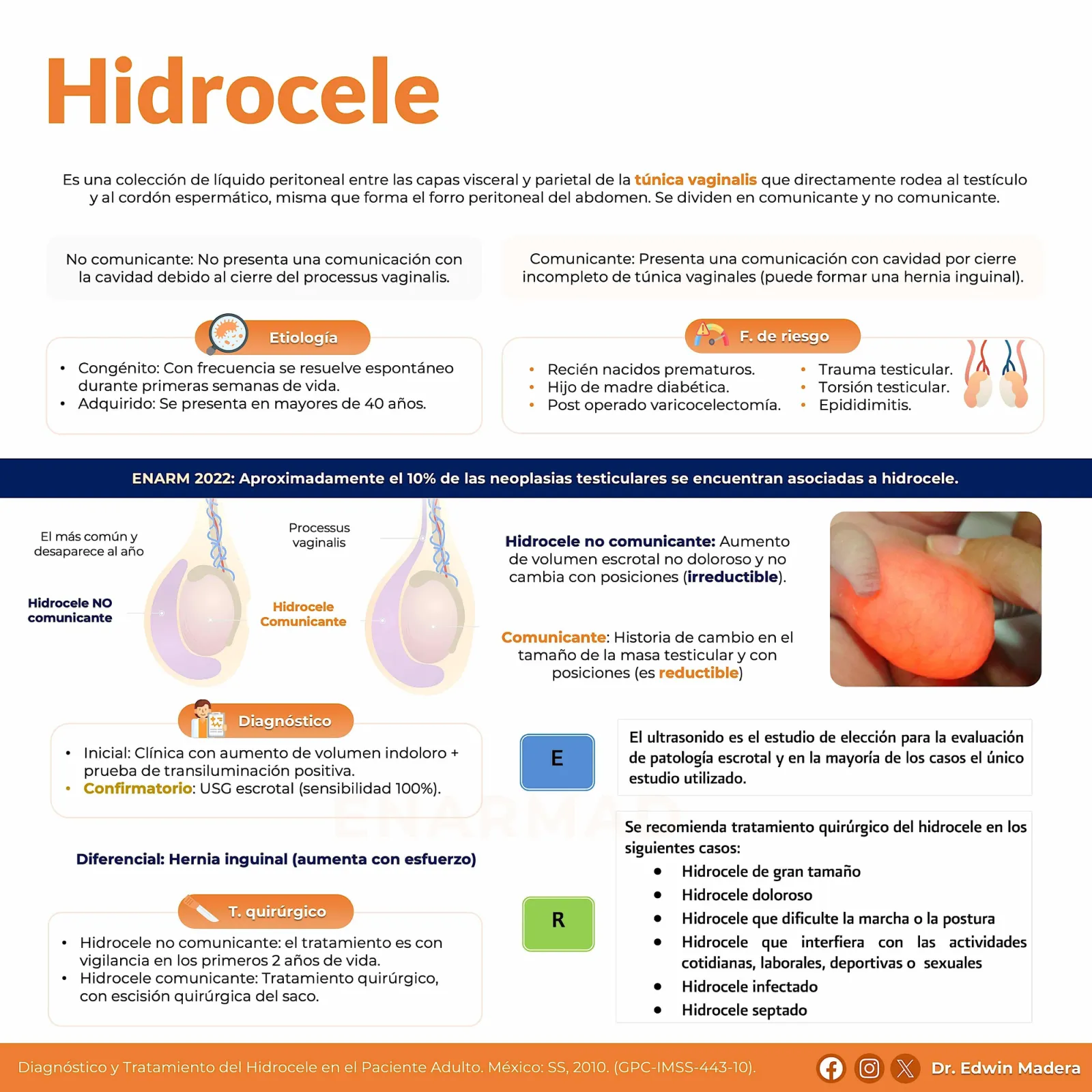 Hidrocele